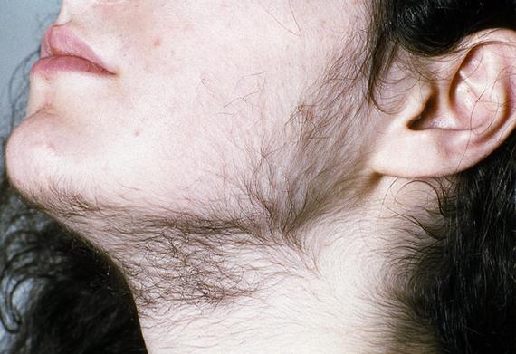 Zap Unwanted Hair: Top Deals on Pro Laser Machines!