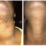 Luminous Secrets: The Hidden Side of Laser Skin Removal