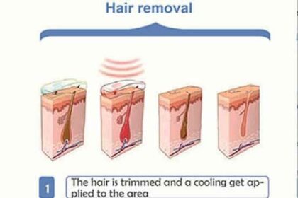 Wave Goodbye to Unwanted Hair: SHR Laser Unveiled!