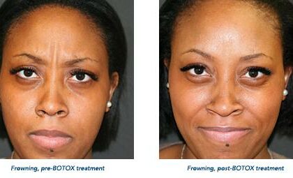 Botox and Laser Treatments: Can They Be Best Friends?