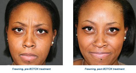 Botox and Laser Treatments: Can They Be Best Friends?