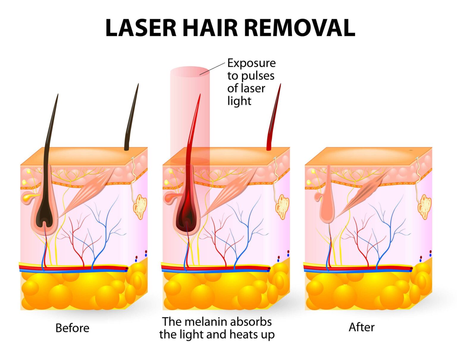 Unveiling Laser Hair Removal Costs in Laurel: Your Guide