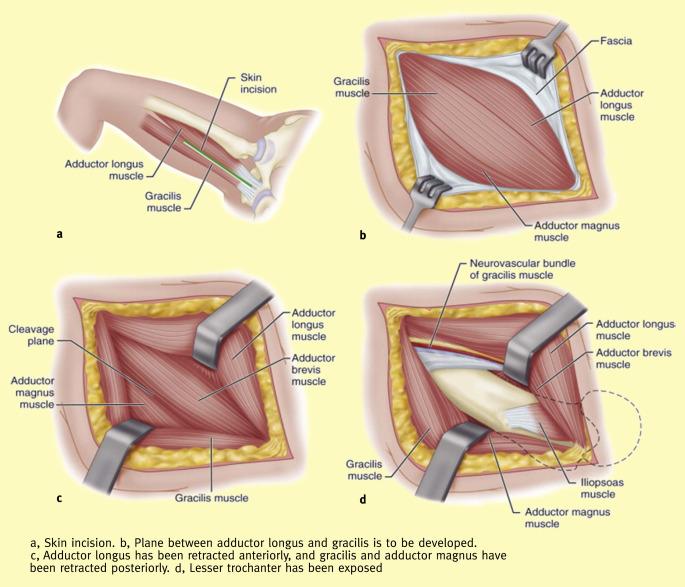Innovative Surgical Approaches to DVT Treatment