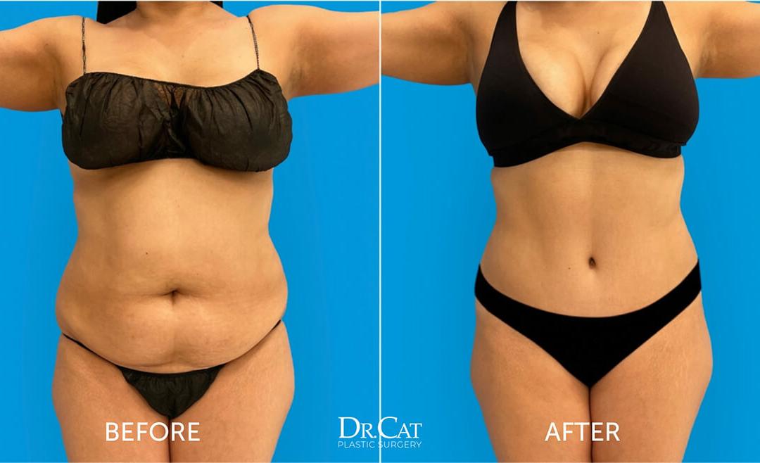 Maintaining Results: Tips for Prolonging Smooth Skin