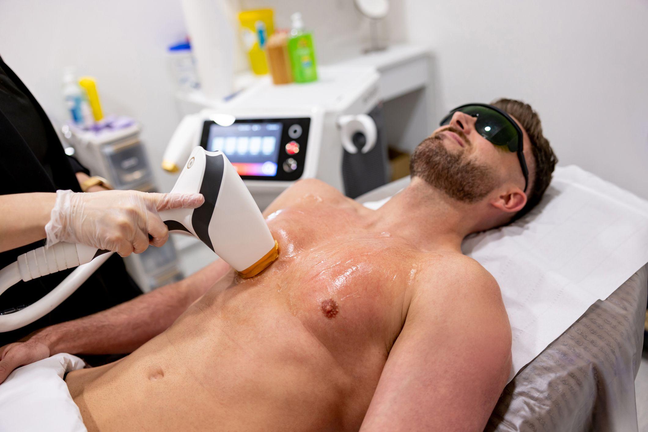 Understanding the Basics: What is ​Laser Hair Removal for Men