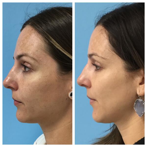 What to Expect: The IPL Treatment Journey​ Unveiled