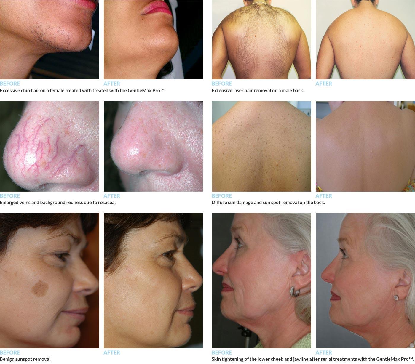 Unlocking the Secrets: What Makes Candela GentleMax Pro Stand Out