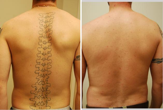 From Sessions to Success: What to Expect in the Tattoo Removal Process
