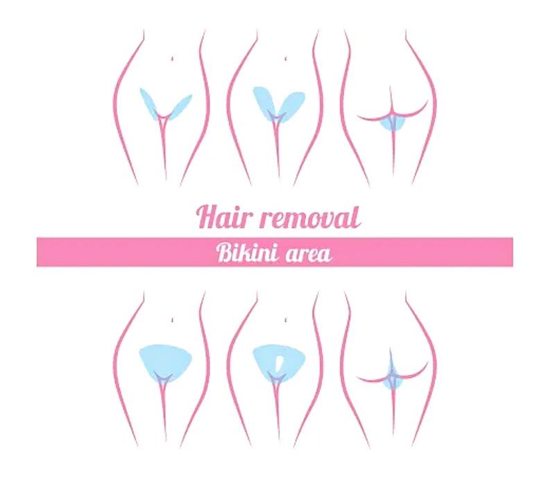 Understanding ‍the Brazilian⁤ Laser: What You Need‍ to Know