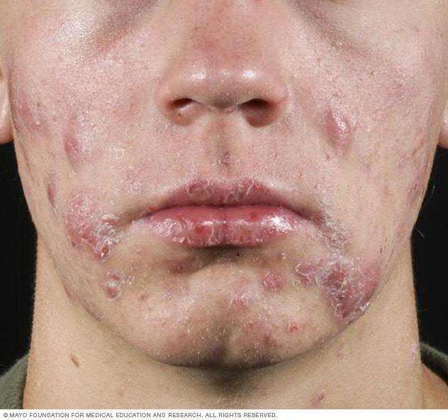 Combating Acne: How ⁢Doxycycline Clears ⁣Up Blemishes