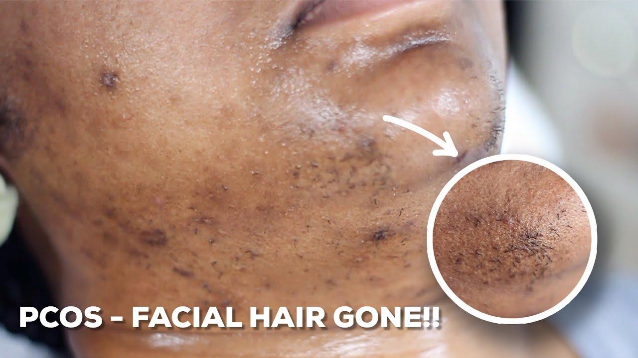 Bidding Goodbye to Stubborn Chin Hairs