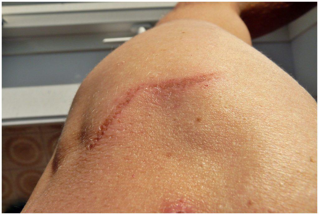 Tattoo Removal Options: Lasers, Creams, and More