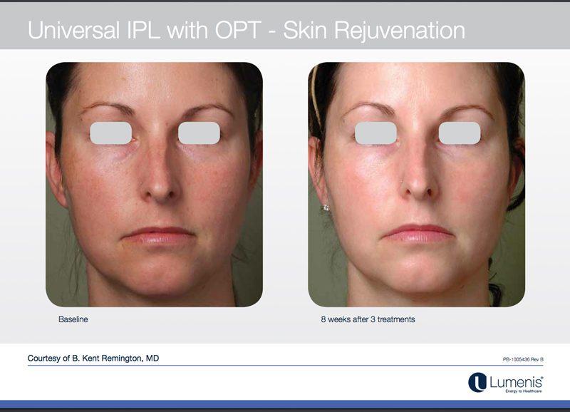 Prepping for Smooth Success: Essential ⁣Tips Before Your IPL Session