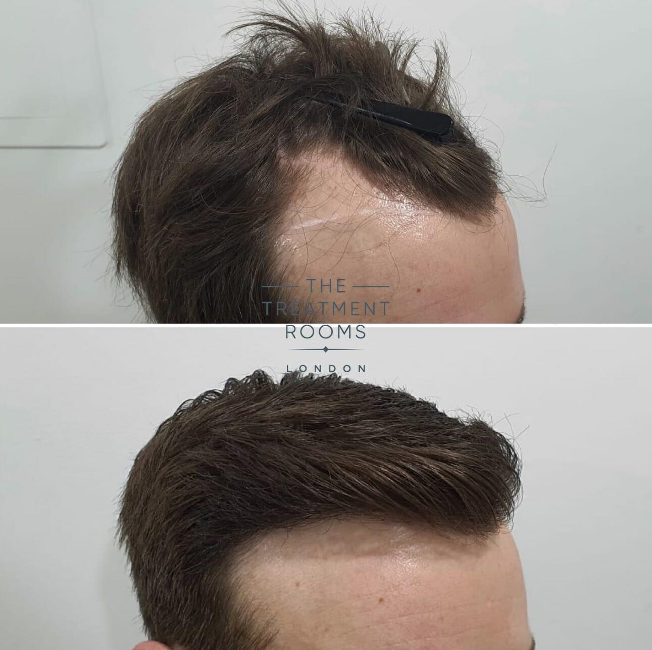 Expert Tips: Preparing for Your ⁤Hairline Laser Procedure