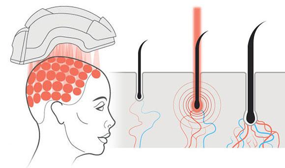 Shedding Light on Hair Loss: LLLT’s Shining Solution 2 Harnessing the Power of Low-Level Laser Therapy (LLLT)