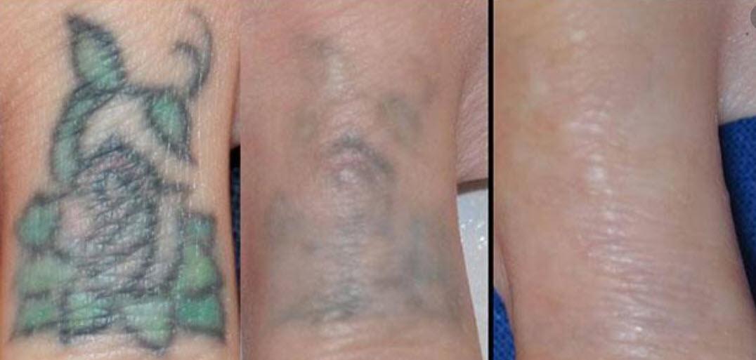 Understanding the Layers: Factors Influencing Tattoo Removal Costs
