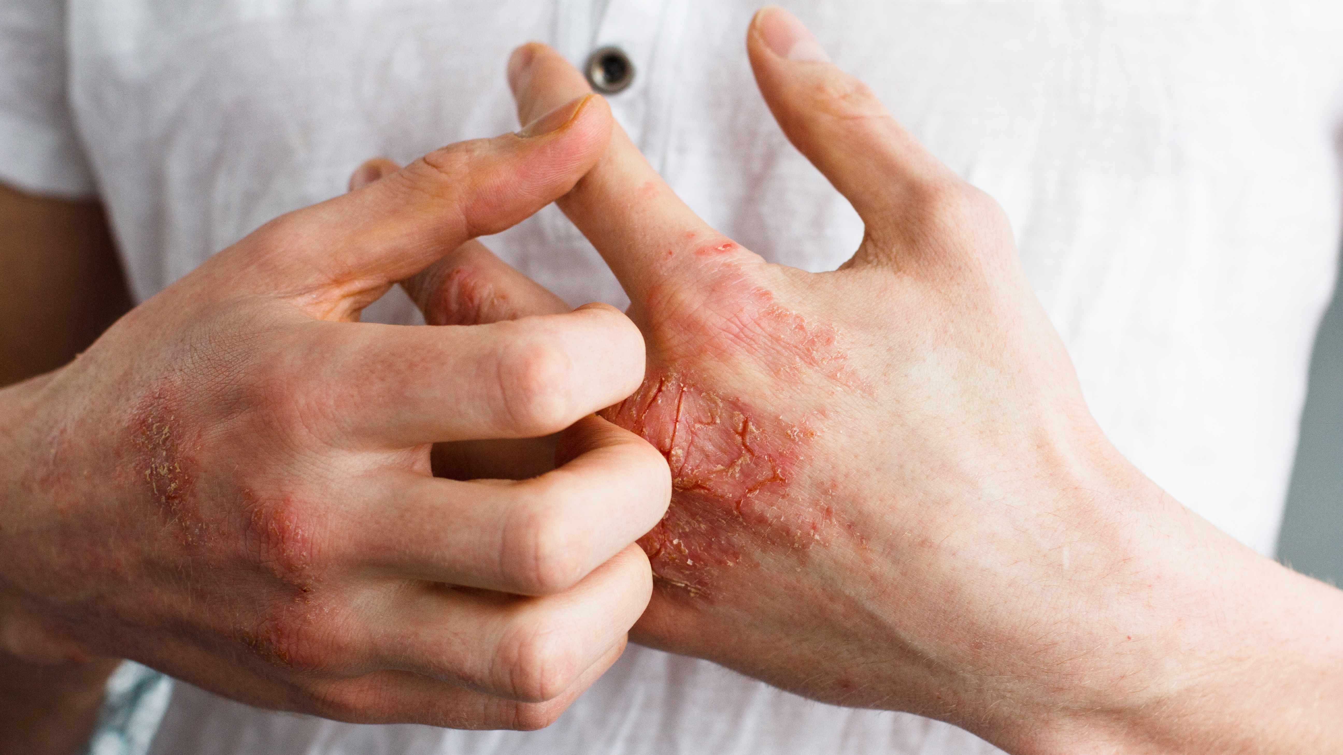 Avoiding Irritation: What to Wear and What to Avoid