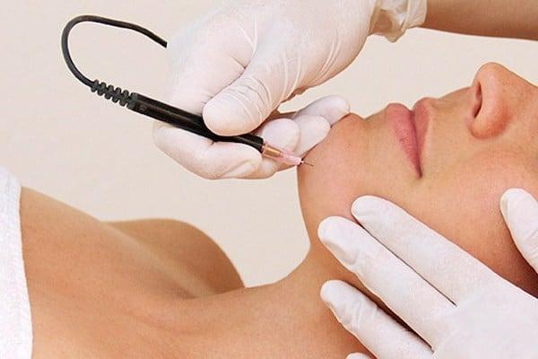 What to Expect During and After Electrolysis Treatment
