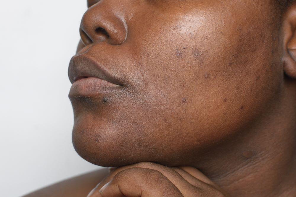 Hyperpigmentation and Hypopigmentation: Keeping ‌Your⁢ Skin Tone Even