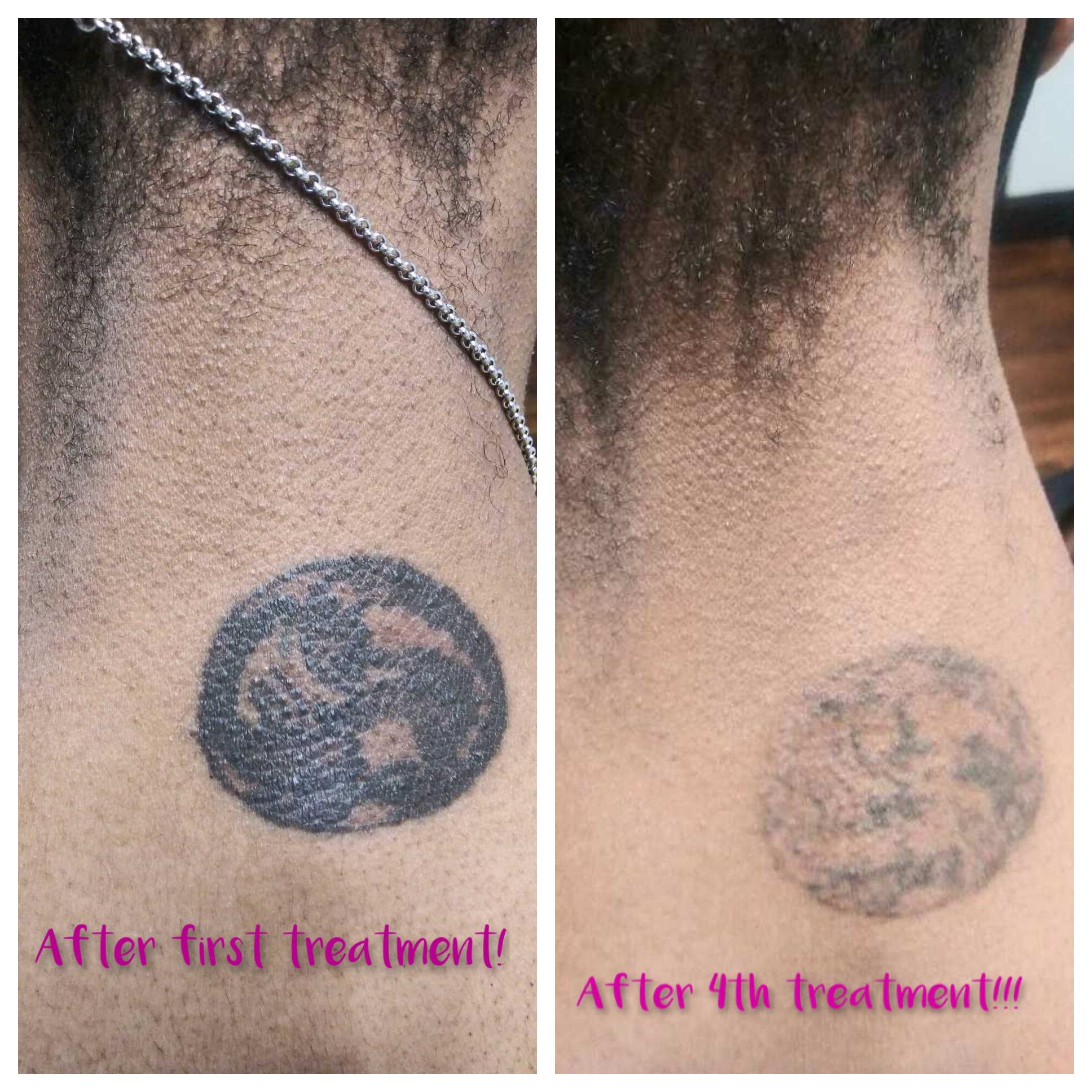 Navigating the Options: Choosing the Best Tattoo Removal Clinic for Your Needs