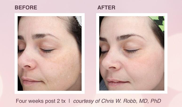 Steps to Optimize Laser Treatment Results with​ Fragrance-Free ⁣Care