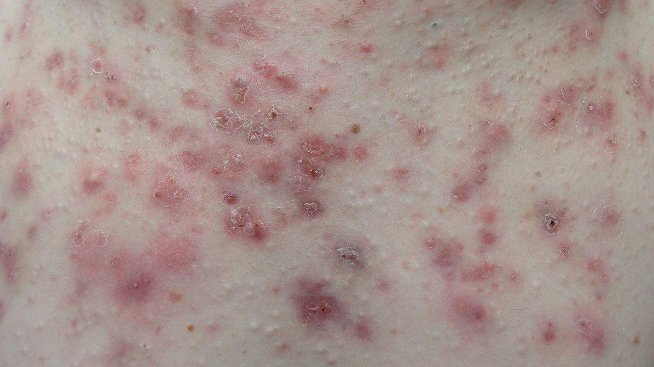 Bumps and Ingrown Hairs: Preventing and Treating Common Side Effects