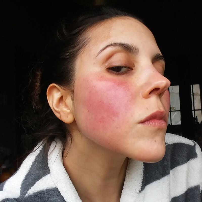 Combatting Redness‌ and Swelling: Easy Home Remedies