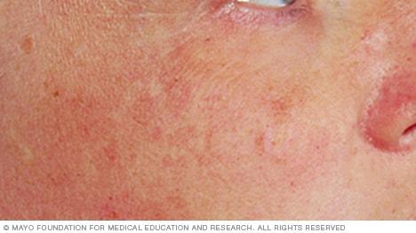 Steering Clear of Sun Damage: Sun ‌Protection ⁢Strategies ‌and Products