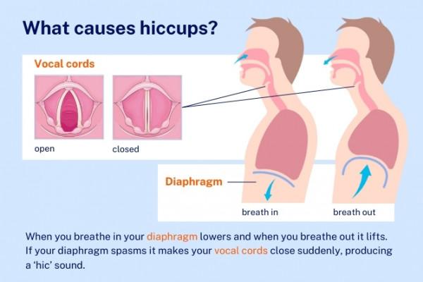Common Hiccups and How to Handle Them Gracefully