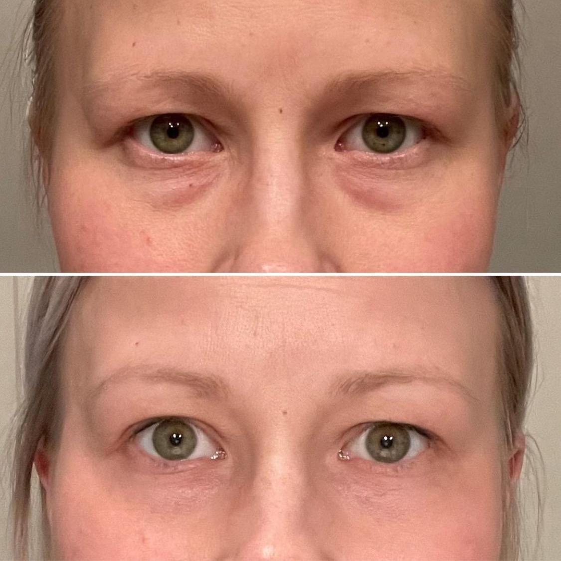 Laser Smooth in Steel City: Sheffield's Top Reviews 2 Overview of Laser Smooth Treatments in Sheffield