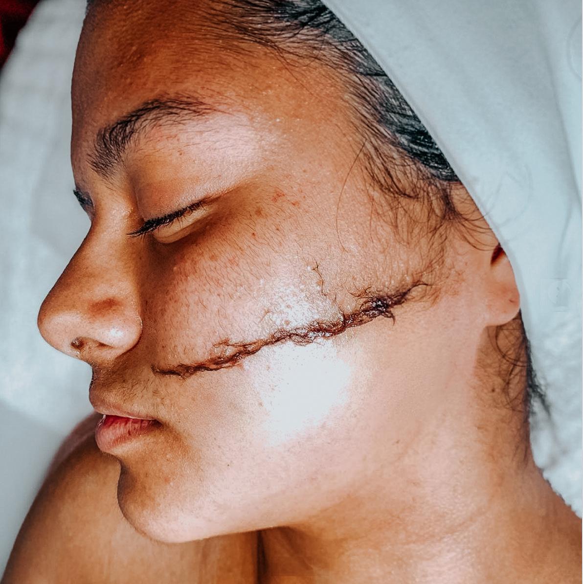 Shedding the Old You: What is Dermaplaning?