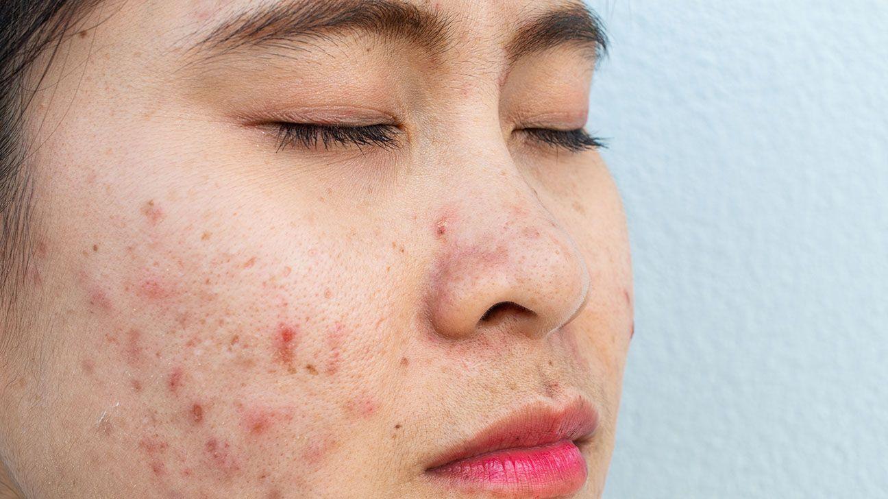 Blemish-Free Bliss: Handling Common Skin Issues in Children