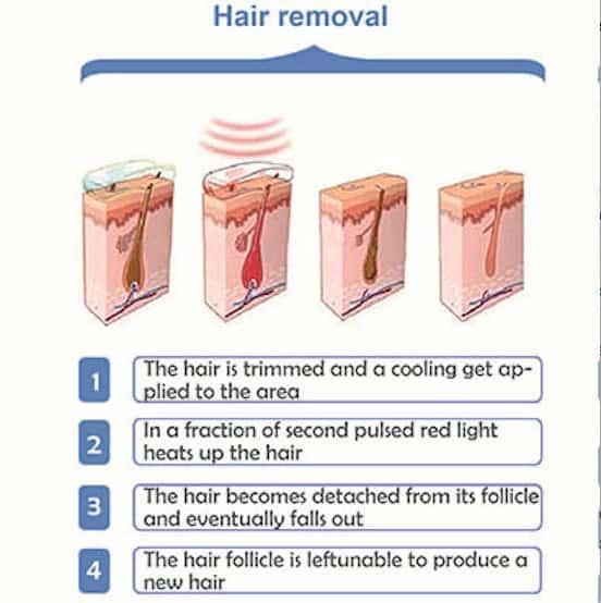 Say Goodbye to Unwanted Hair with SHR at Affinity! 5 Preparing for Your First SHR Session: Tips from the Experts