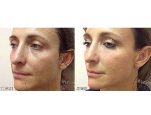 Skin-Specific Recommendations‍ for ​Various Laser Treatments