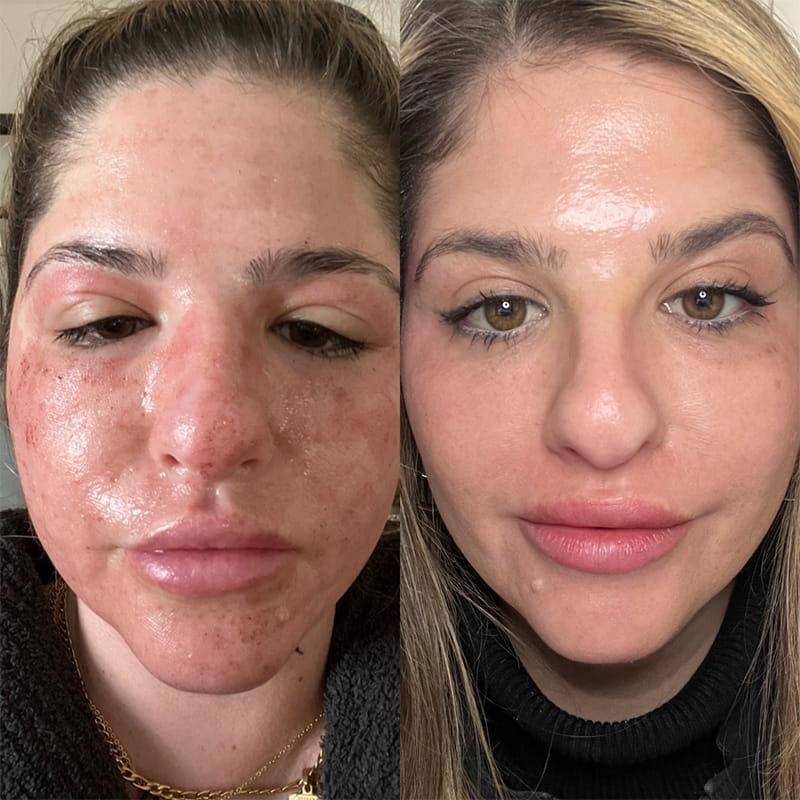 Expert‌ Tips: ⁤Maximizing ​Results and ‍Minimizing Risks with CO2 Laser⁤ Therapy