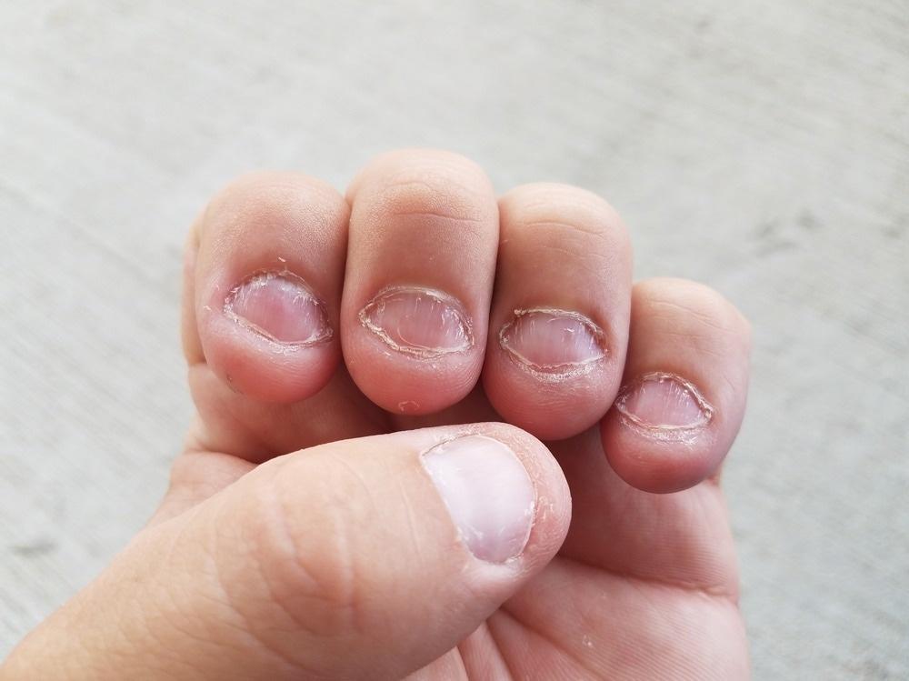 Nail Biting or Nail Telling? What Your Nails Reveal About Your Stress Levels