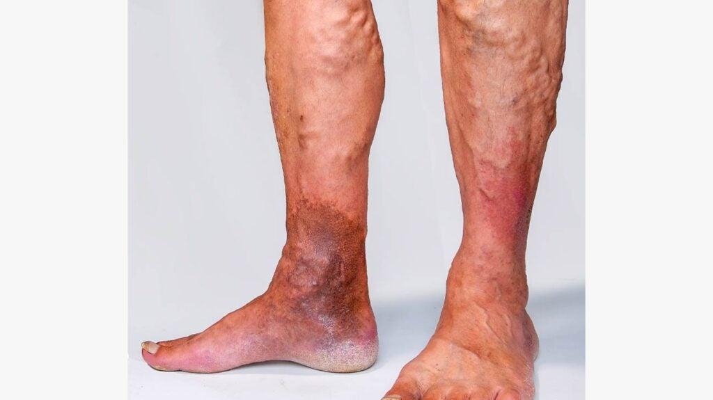 Varicose Veins Unveiled: Understanding the Causes and Risks