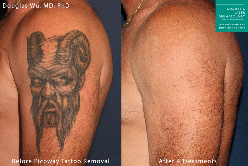 Ink No More: The ‍Science Behind Laser ‍Tattoo⁣ Removal