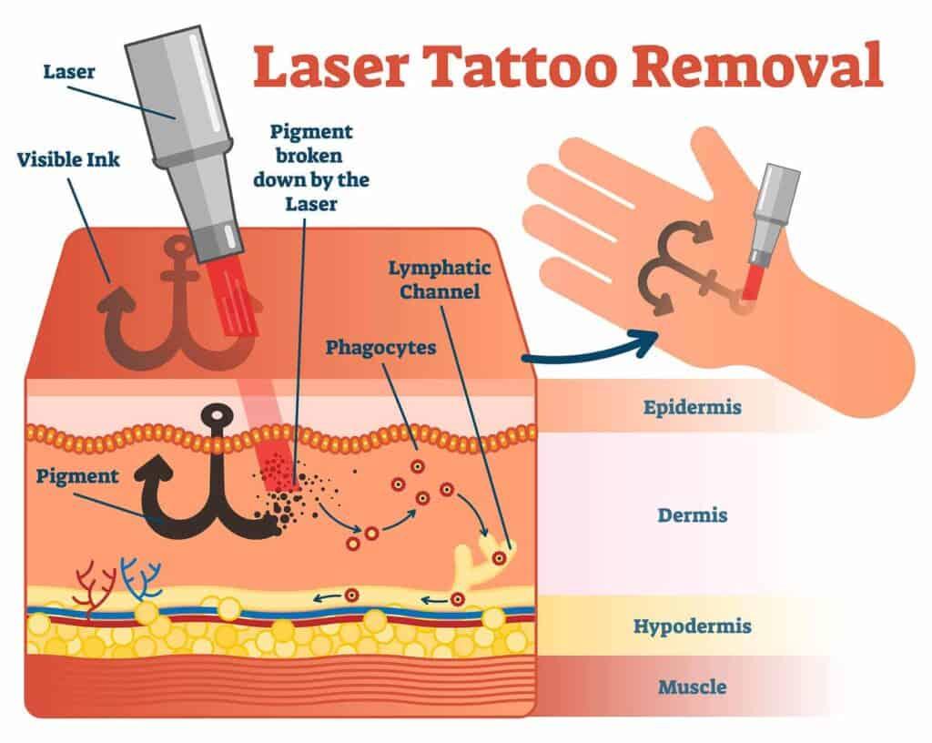 What ‍to ⁤Expect: The Step-by-Step ⁢Removal Process