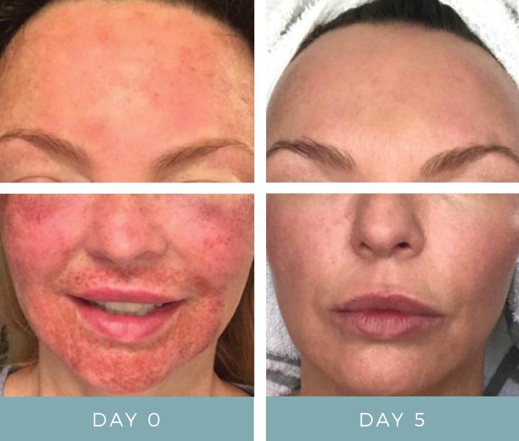 Post-Laser Lifestyle: Habits to Avoid for Optimal Healing