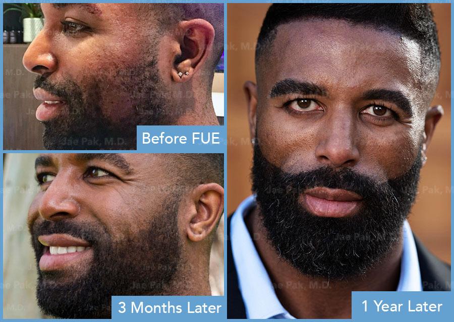 When Patchy Meets Patience: Timeline for Initial Results