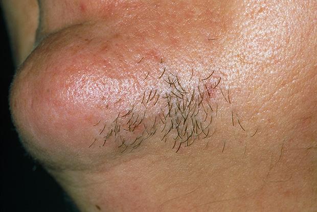 Understanding Hirsutism: The Roots of Unwanted Hair