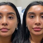 Beauty Reinvented: Fillers, Lasers, and Botox Bliss