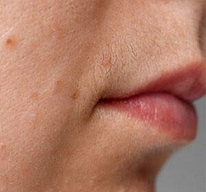 Zap Unwanted Facial Hair: Your DIY Laser Guide 🌟