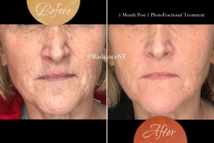 Post-Laser Radiance: The Ultimate Guide to Aftercare Creams 18 Post-Laser Radiance: The Ultimate Guide to Aftercare Creams