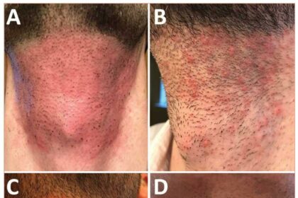 Post-Laser Hair Removal: Timing Your Moisturizer Routine 14 Post-Laser Hair Removal: Timing Your Moisturizer Routine