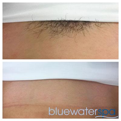Ensuring Smooth Skin: Essential Aftercare for Brazilian Laser