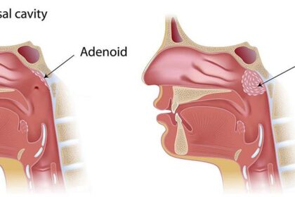Navigating Adenoidectomy: Journey Through Surgery & Healing 4 Navigating Adenoidectomy: Journey Through Surgery & Healing