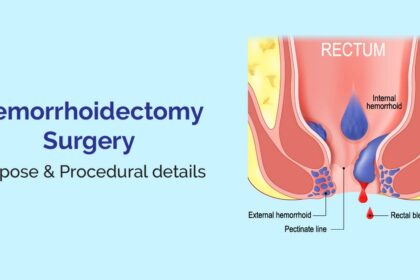 Navigating Hemorrhoidectomy: Surgery, Recovery & Risks