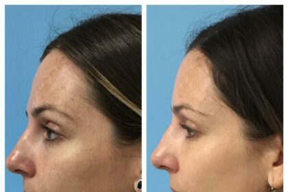 Zap Unwanted Hair: Your Guide to IPL Laser Magic!